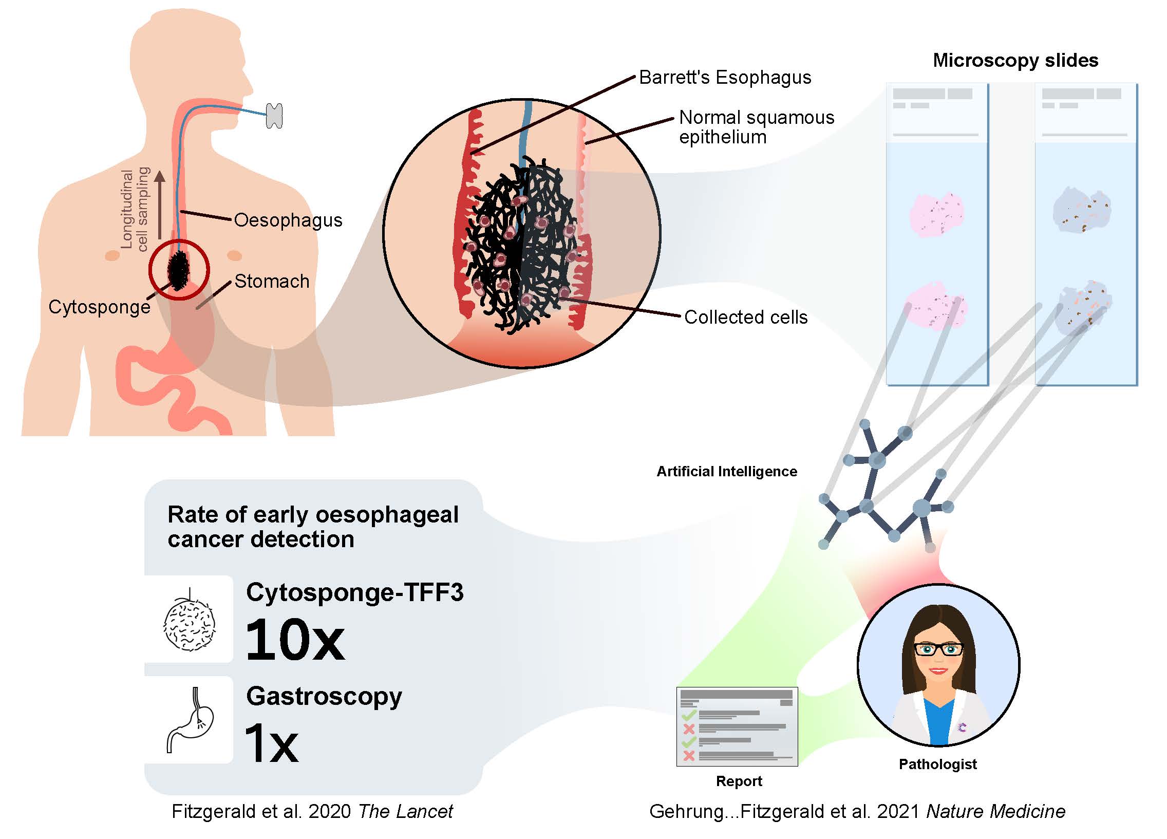 Cytosponge cartoon